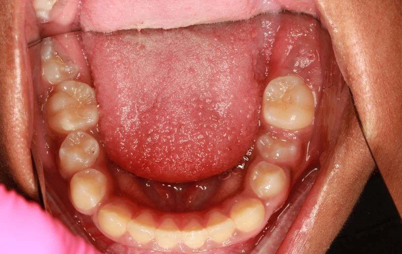 Lower - After Treatment