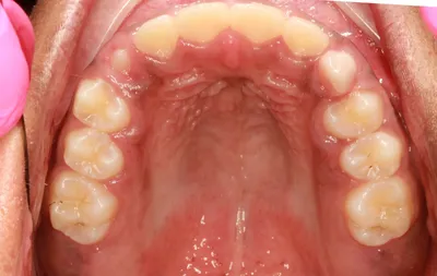 After Metal Braces treatment - Case 98164