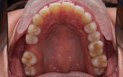 Before Metal Braces treatment - Case 98163