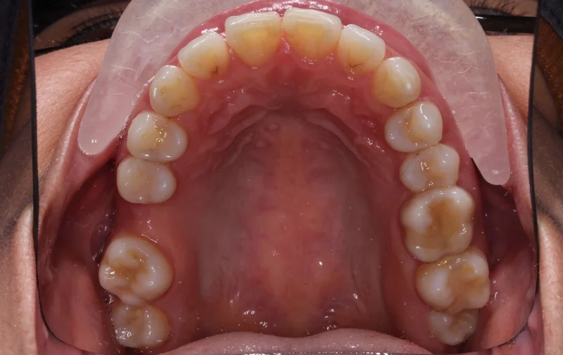 Upper - Before Treatment