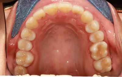 After Metal Braces treatment - Case 98163