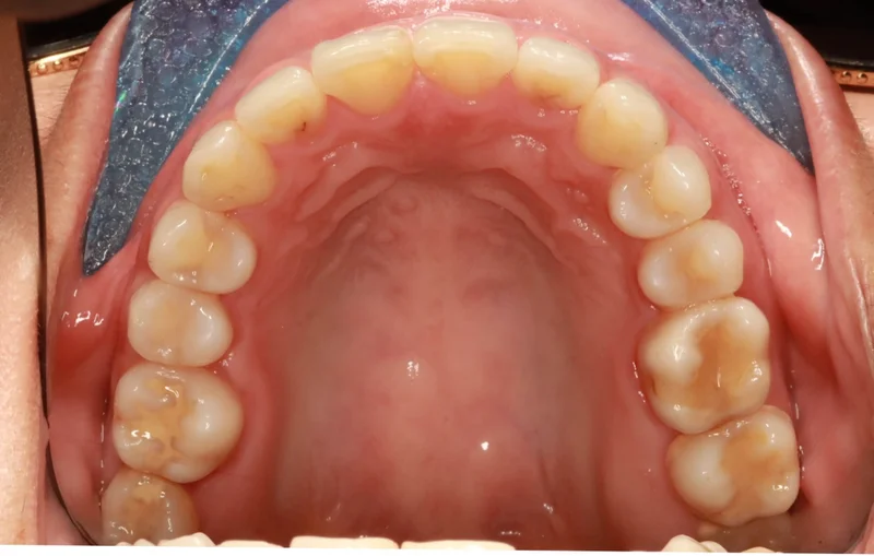 Upper - After Treatment