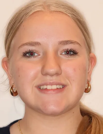 After Metal Braces treatment - Case 102669