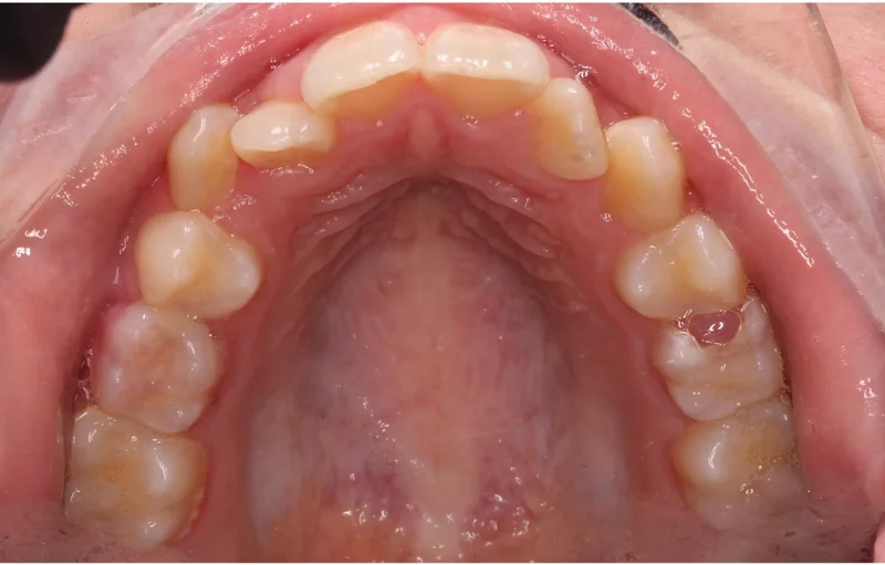 Upper - Before Treatment