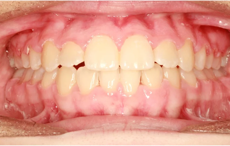 Center - After Treatment