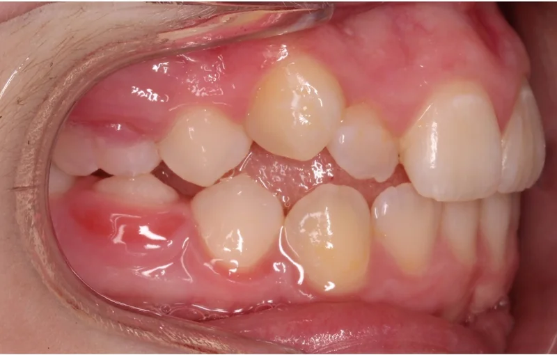 Buccal Right - Before Treatment