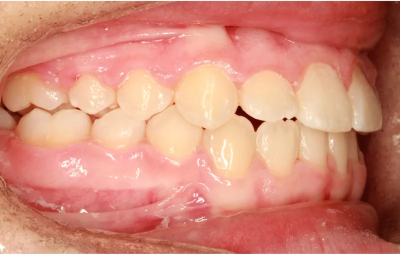 Buccal Right - After Treatment