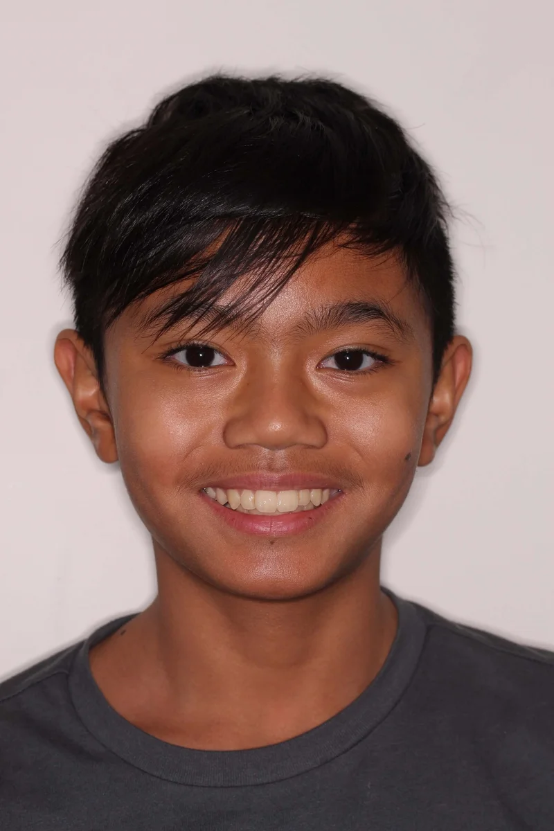 Facial Frontal - Before Treatment