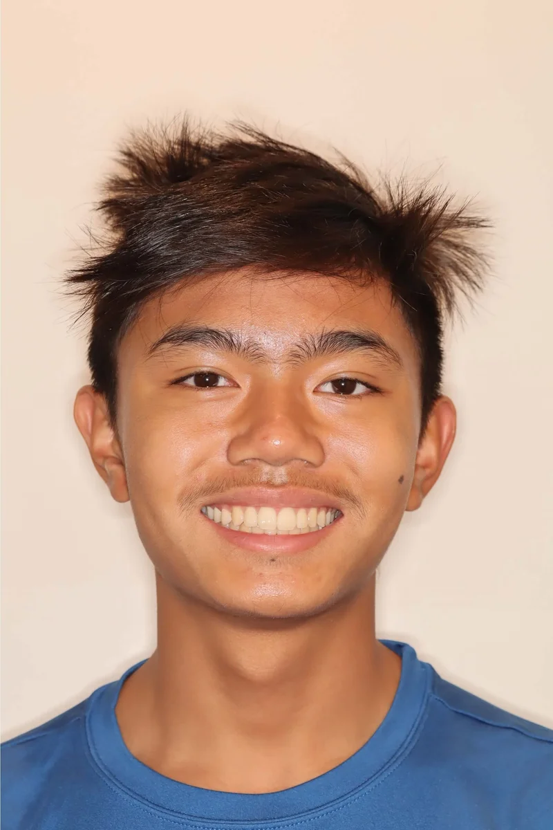 Facial Frontal - After Treatment