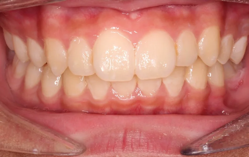 Center - Before Treatment