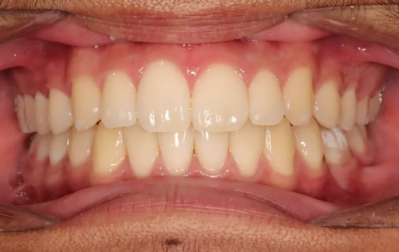 Center - After Treatment