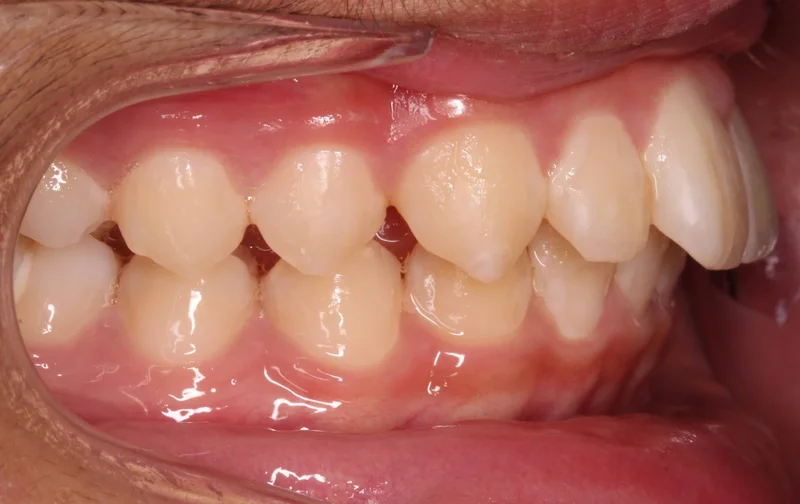 Buccal Right - Before Treatment
