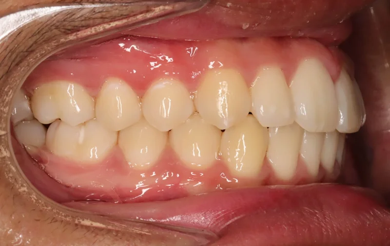 Buccal Right - After Treatment