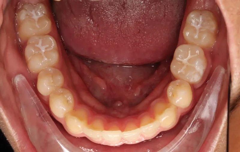 Occlusal Lower - After Treatment