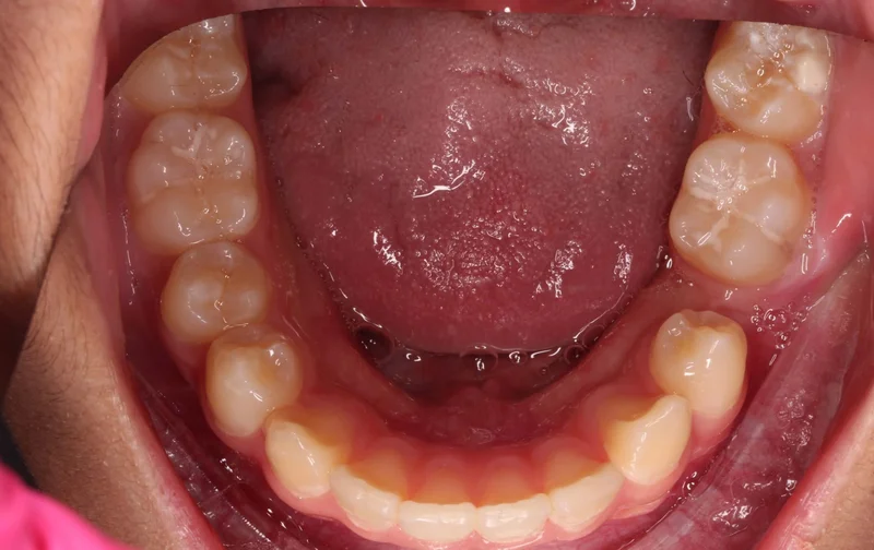 Occlusal Lower - Before Treatment