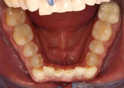 Before Metal Braces treatment - Case 42526
