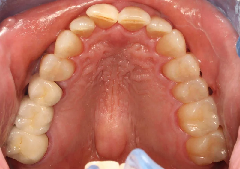 Upper Occlusal View - Before Treatment