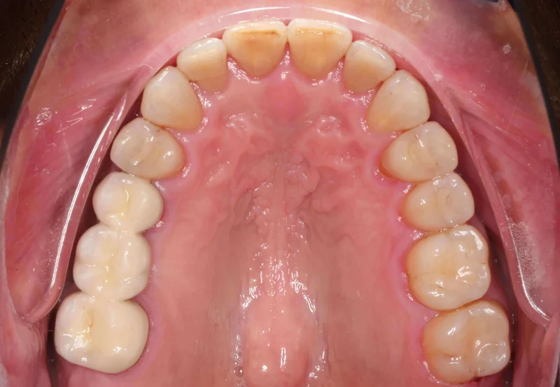 Upper Occlusal View - After Treatment