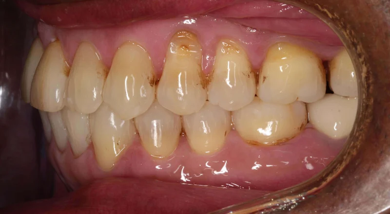 Left Buccal View - After Treatment