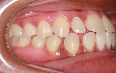 Before Metal Braces treatment - Case 42721