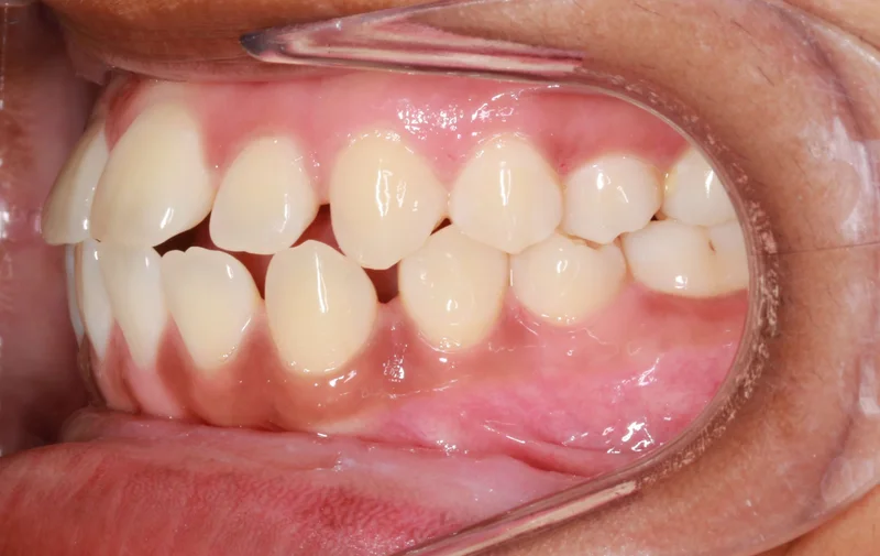 Left Buccal View - Before Treatment