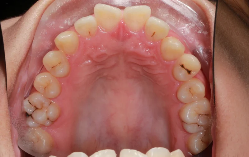 Upper Occlusal View - Before Treatment