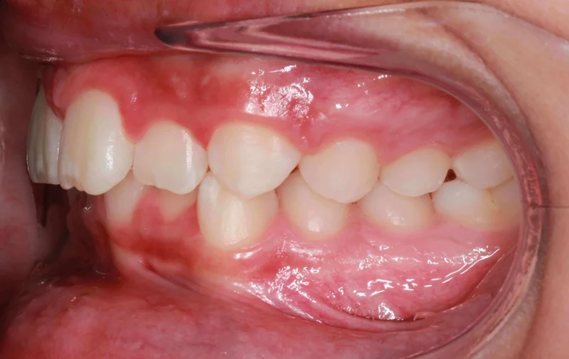 Left Buccal View - Before Treatment