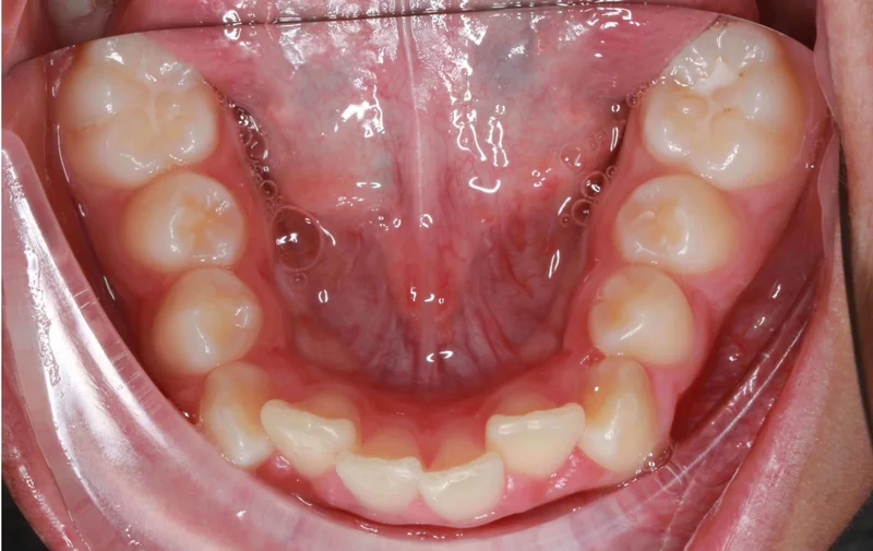 Lower Occlusal View - Before Treatment