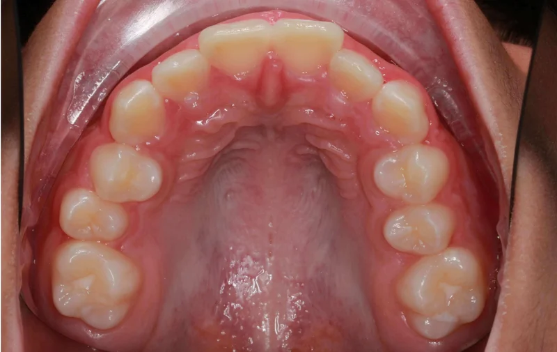 Upper Occlusal View - Before Treatment