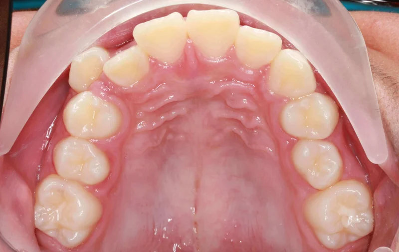 Upper Arch - Before Treatment