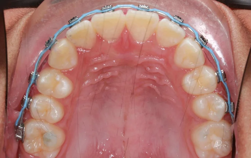 Upper Arch - After Treatment