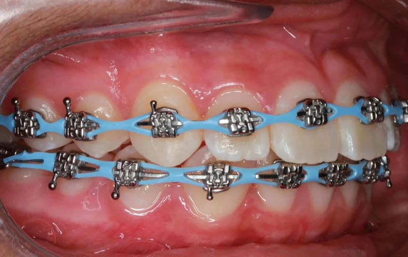 Right side view - After Treatment