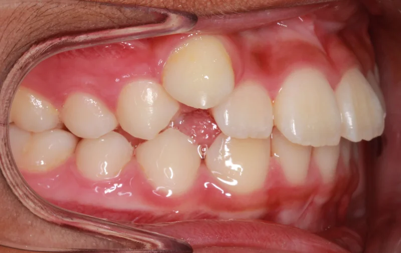 Right side view - Before Treatment