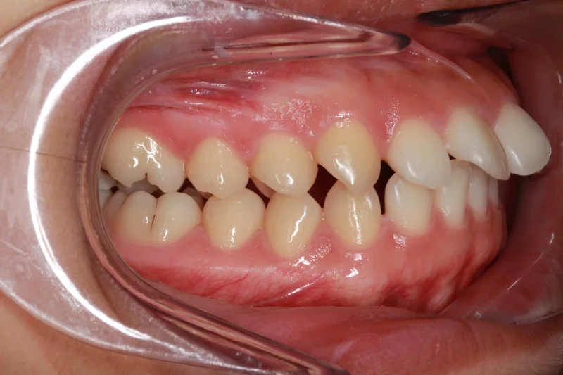 Right Buccal View - Before Treatment