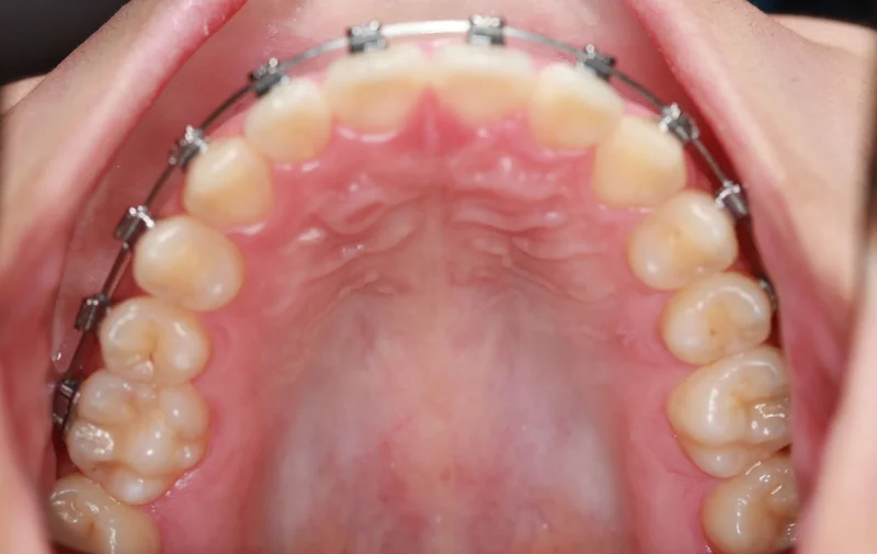 Upper Occlusal View - After Treatment