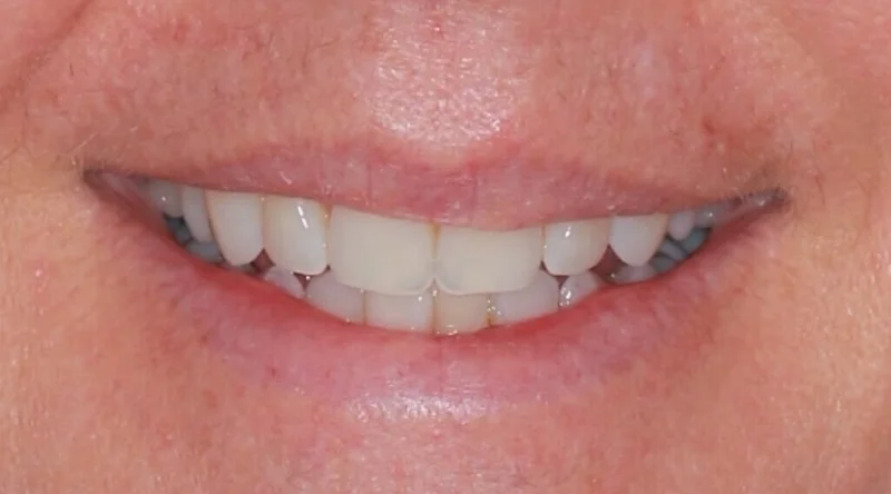 Smiling - Before Treatment