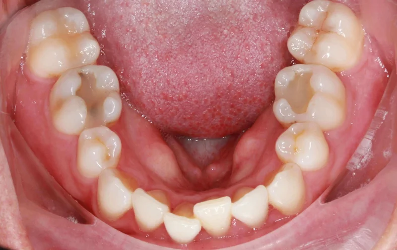 Lower View - Before Treatment