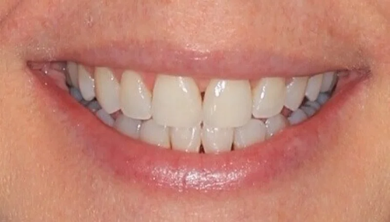 Smiling - After Treatment