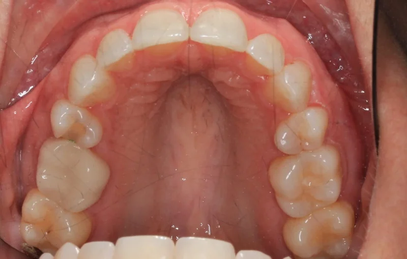 Upper View - After Treatment