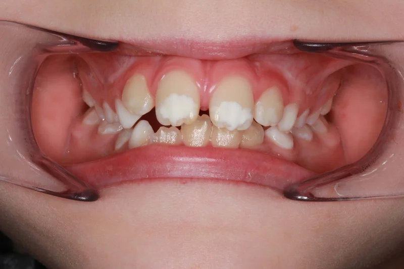Center Bite - Before Treatment