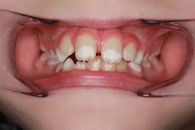 Before Metal Braces treatment - Case 51927