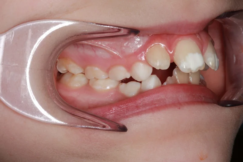 Right Side Bite - Before Treatment