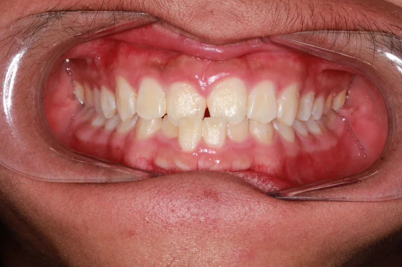 Center Bite - Before Treatment