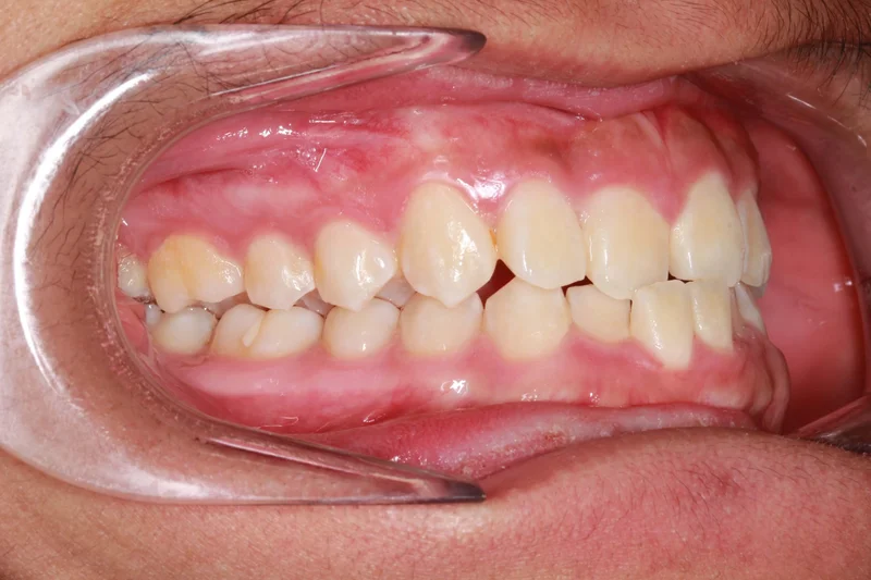 Buccal Right - Before Treatment