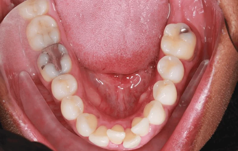 Lower Occlusal View - Before Treatment