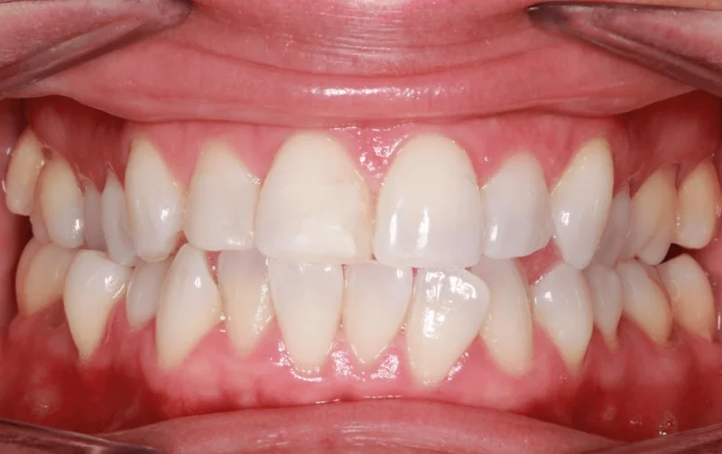 Center Bite - Before Treatment