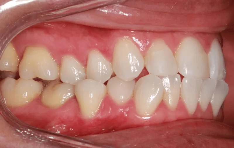 Right Side Bite - Before Treatment