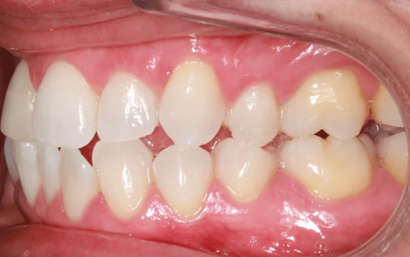 Left Side Bite - Before Treatment