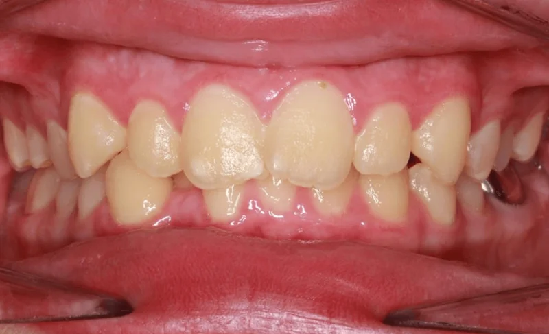 Center Bite - Before Treatment