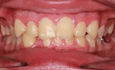 Before Metal Braces treatment - Case 59665
